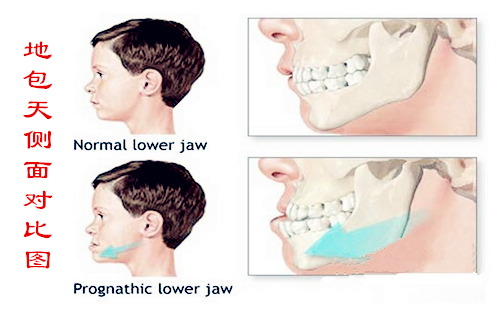 儿童地包天矫正有哪些要注意的